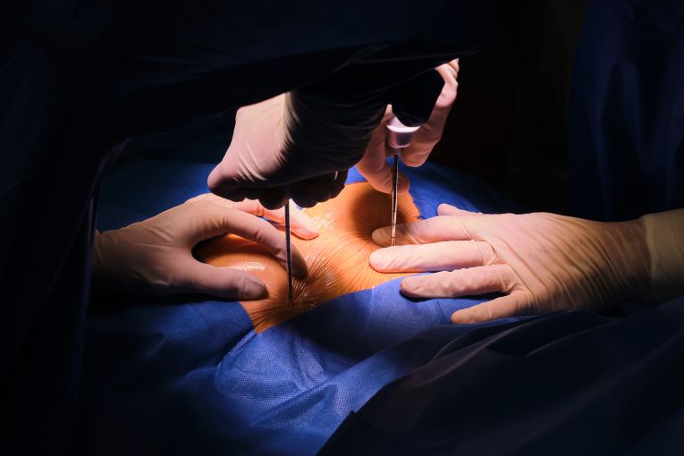 와이어 장력 이용한 생검장치로 단단한 조직 채취 기술 개발 썸네일