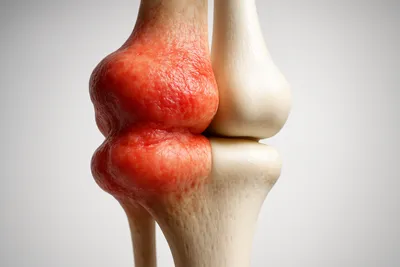 관절 염증 및 붓기 효과적 억제 류마티스 치료 조성물 개발 썸네일